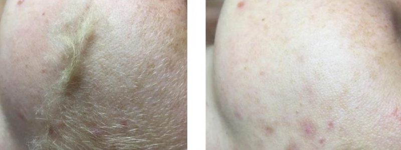 Tijdens en na dermaplaning